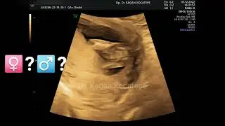 13 haftalık gebelikte ultrasonda cinsiyet nasıl görülür? Bebek kız mı erkek mi ne zaman belli olur?