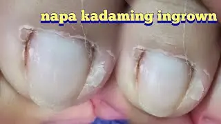 How to cut thick toenails - Toenail cleaning satisfying💚