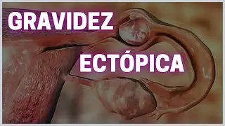 Gravidez ectópica - Fisiologia Humana