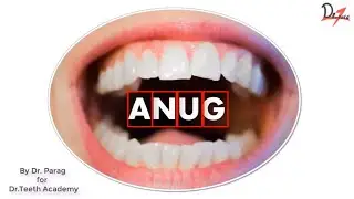ANUG | Acute necrotizing ulcerative gingivitis |
