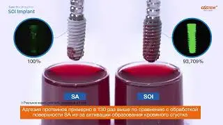 Новые имплантаты TSIII SOI
