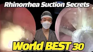 Rhinorrhea Suction Scerets : World Best 30 (세계최고 콧물제거영상)