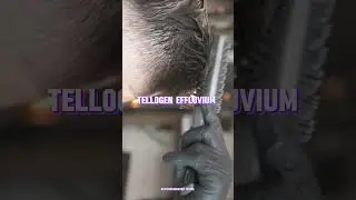 How Stress Can Cause Hair Fall: Unveiling the Connection#glitchinthematrix  #youtubeshorts #stress