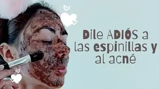 Dile ADIÓS a las espinillas y al acné