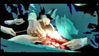 Draconian Method viral infektion V2