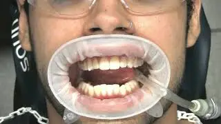 Cómo Remover Resinas