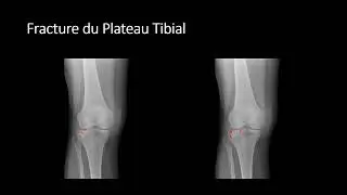 Genou  Partie 2