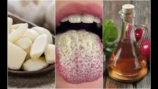Hoe beheers je Candida Albicans met zes natuurlijke middelen?