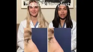 Liquid Rhinoplasty with Sam & Meg