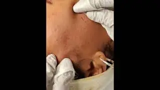 Extractions full face