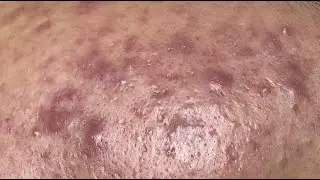 Acne treatment for Hoang (P.2)  #HoangMySpa112