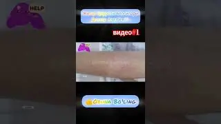 жигар циррози белгилари 1