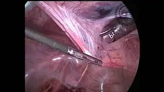 An operative guide to laparoscopic dissection in total pelvic exenteration