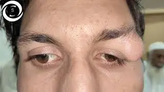 Ophthalmic Signs Orbit