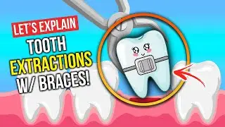 Do Extractions with Braces Have Side Effects?!