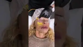 Мезонити под глазами.