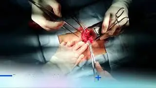 Así se ve una cirugía de hernia inguinal