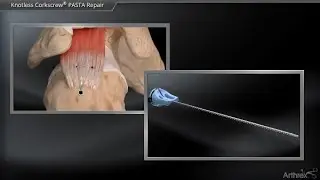 Knotless Corkscrew® PASTA Repair
