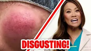 The GROSSEST & MOST DISGUSTING Moments on Dr. Pimple Popper!