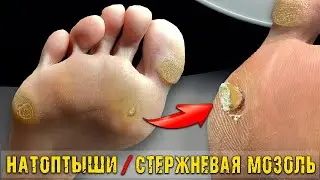 Pedicure WITH CUTLERY?! Corn 🤯 because of the Nail. Deep callus. PEDICURE. MASSIVE CORN