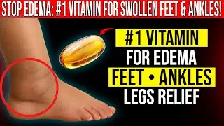 STOP Edema! The #1 Vitamin That Instantly Calms Swollen Feet, Ankles, and Legs