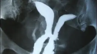Reconstruction of complete vaginal cervical uterine septum by Shawki