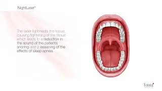 💤 Stop Snoring for Good! NightLase® Snoring Treatment with Fotona Laser