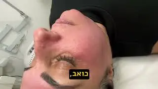 ✨פילינג עמוק Deep Peeling לAnti-aging אנטי אייג'ינג !!! 050-3581765 סינדרלה היופי שבך