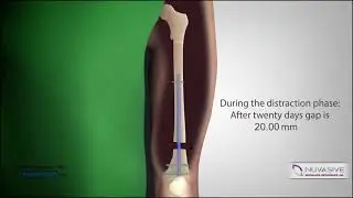 PRECICE Retrograde Femur Animation