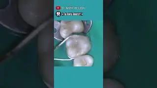 Amazing Restoration of A Fractured Tooth 