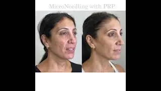 Microneedling with PRP | Boca Raton Dermatologist