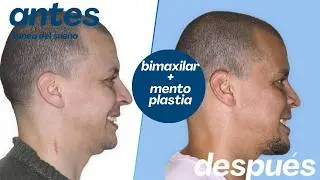 Cirugía bimaxilar Caso #152:  Samir- Apnea obstructiva del sueño, retrusión maxilo-mandibular