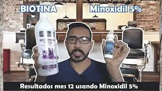Mes 12 usando Minoxidil 5%Resultados