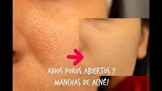 CIERRA LOS POROS ABIERTOS Y MANCHAS POR EL ACNÉ- Para siempre