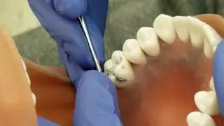 Amalgam Restoration Tooth #3 OOL Part 2 of 2