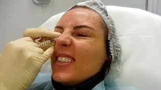 MY FIRST BOTOX. I GAVE UP. BEFORE AND AFTER.
