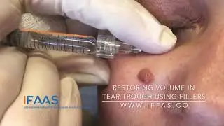IFAAS Exclusive Techniques - Restoring Volume in Tear Trough using Fillers