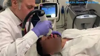 Unbelievable Scar Disappearance! Erbium Glass Laser Treatment #scarstreatment #lasertherapy