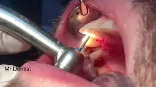 Preparation For A Crown On A Frontal Tooth  -  Upper Canine Preparation !!!