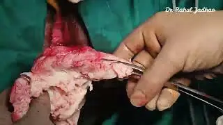 Cervical myomectomy at nondescent vaginal hysterectomy