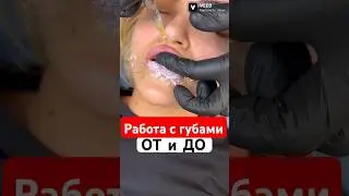 What others won't tell you! The entire lip augmentation process 