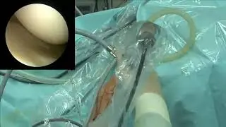 Knee arthroscope.. Portals and examination