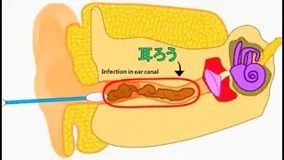 耳ろう除去2Dアニメーション  -  Ear wax removal