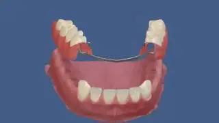 Бюгельный нижний протез с кламмерной фиксацией