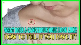 What Does A Cancerous Mole Look Like? - How To Tell If A Mole Is Cancerous | Best Home Remedies