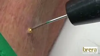 Remove Skin tag - Plasmage ®