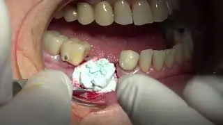 Extraction and Implant Placement with Bond Apatite