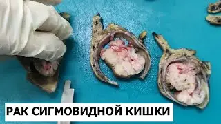 Рак толстой кишки #4 - гистологическое исследование рака сигмовидной кишки