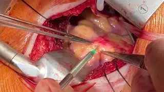Minimally Invasive Myocardial Bridge Unroofing