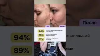 POV: когда съехал от родителей ❤️Арт.на WB: 142054898 сыворотка от прыщей #прыщи #акне #wildberries